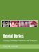 Dental Caries: Etiology, Pathology, Prevention, and Treatment