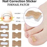 Superdealer Cheaperito Teennagel Lifter I Ingegroeide teennagel Corrector I Teennagel Pleister I Anti Ingroei Pleister I Nagel Correctie Kit I 30 stuk