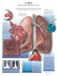 3B Scientific schoolbord CHRONISCH obstructieve longsinfectie, laminated, 1